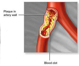 plaques in arteries